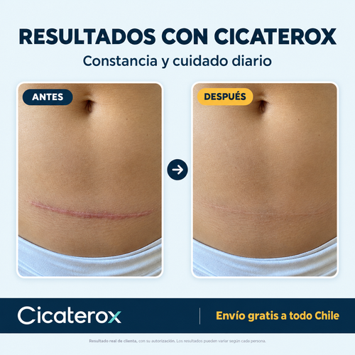 Cicaterox – Spray para Eliminar Cicatrices